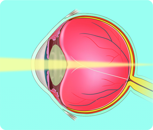 refractiva-4